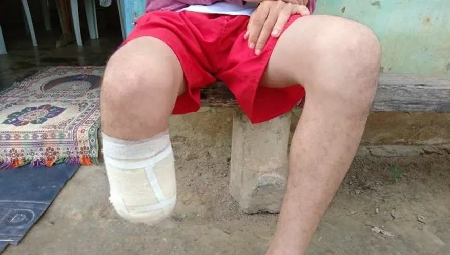 Imagem de Servidor que amputou o pé para receber seguro de R$ 1,5 milhão sofre derrota na Justiça