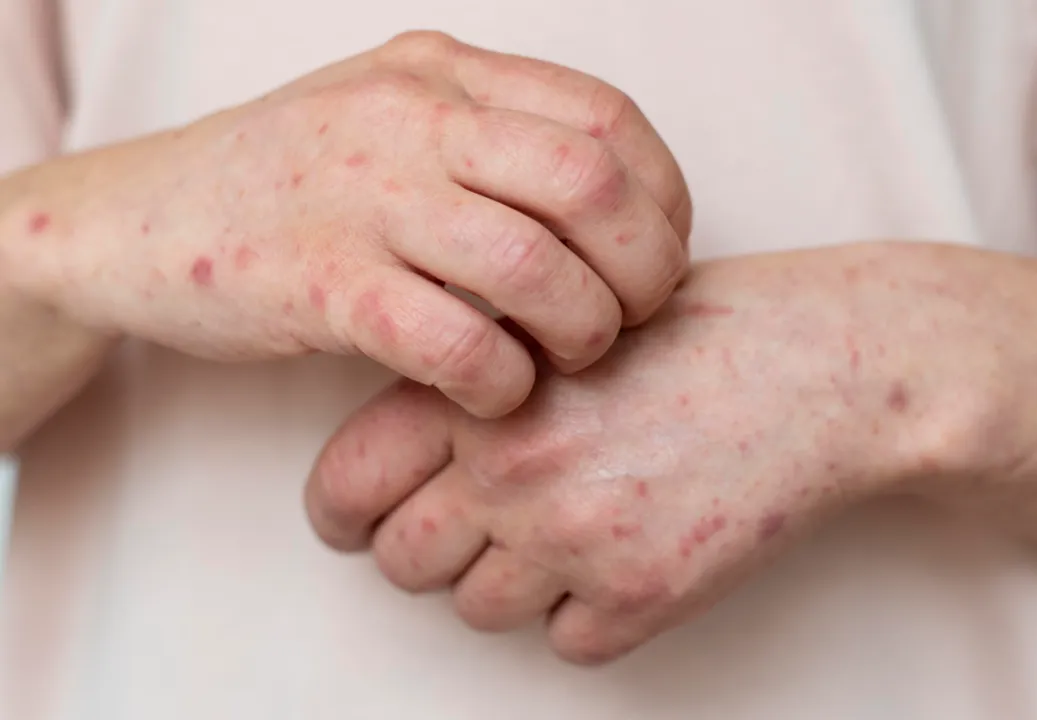 Imagem de Ministério da Saúde emite alerta máximo após avanço da Mpox no Brasil